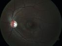 HereditaryAD-optic-atrophy_son_joarc_120119_03.jpg