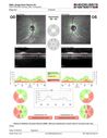 HereditaryAD-optic-atrophy_son_joarc_120119_07.JPG