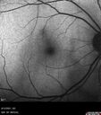 Idiopathic-CNVM_081221_anvir_06.jpg