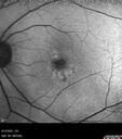 Idiopathic-CNVM_081221_anvir_07.jpg