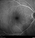 Idiopathic-CNVM_081221_anvir_10.jpg