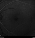 Idiopathic-CNVM_081221_anvir_11.jpg