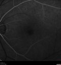 Idiopathic-CNVM_081221_anvir_12.jpg