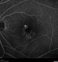 Idiopathic-CNVM_081221_anvir_17.jpg