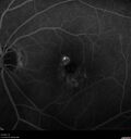 Idiopathic-CNVM_081221_anvir_18.jpg