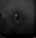 Idiopathic-CNVM_081221_anvir_19.jpg