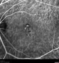 Idiopathic-CNVM_081221_anvir_23.jpg