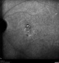Idiopathic-CNVM_081221_anvir_26.jpg