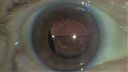 Iris_cyst_robra_012021_02.jpg