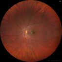 MEWDS_Six_weeks_later_-_vision_20-16_01.jpg