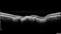 MacLaserScar-pohs_jolin_012617_10.jpg