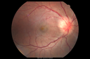 Neuroretinitis_RaCu_090314_01.png