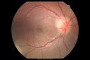 Neuroretinitis_RaCu_090314_02~0.png