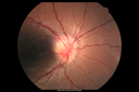 Neuroretinitis_RaCu_090314_03.png