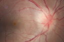 Neuroretinitis_RaCu_090314_04.png