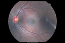 Neuroretinitis_RaCu_090314_05~0.png