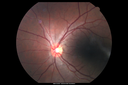 Neuroretinitis_RaCu_090314_06.png