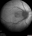 Neuroretinitis_RaCu_090314_07.jpg