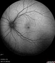 Neuroretinitis_RaCu_090314_08.jpg