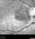 Neuroretinitis_RaCu_090314_10.jpg