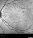 Neuroretinitis_RaCu_090314_12~0.jpg