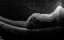 Neuroretinitis_RaCu_090314_14.jpg