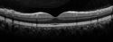 Neuroretinitis_RaCu_090314_16.jpg