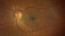 Neuroretinitis_gwcal_081221_02.jpg
