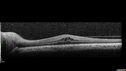 Neuroretinitis_gwcal_081221_05.jpg