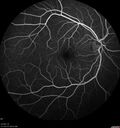 Neuroretinitis_gwcal_081221_06.jpg