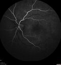 Neuroretinitis_gwcal_081221_08.jpg
