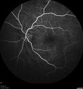 Neuroretinitis_gwcal_081221_09.jpg
