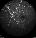Neuroretinitis_gwcal_081221_10.jpg