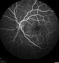 Neuroretinitis_gwcal_081221_11.jpg