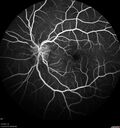 Neuroretinitis_gwcal_081221_12.jpg