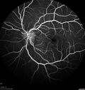 Neuroretinitis_gwcal_081221_13.jpg