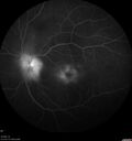 Neuroretinitis_gwcal_081221_16.jpg