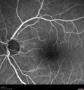 Normal_Fluorescein_Angiogram__01.jpg
