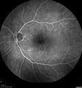 Normal_Fluorescein_Angiogram__02.jpg