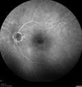 Normal_Fluorescein_Angiogram__04.jpg