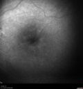 Normal_Fluorescein_Angiogram__05.jpg