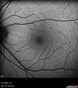 Normal_Fundus_Autofluorescence_30_degrees_28129.jpg