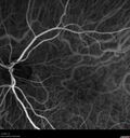 Normal_Indocyanine_Green_Angiogram__01.jpg