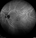Normal_Indocyanine_Green_Angiogram__04.jpg