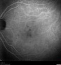 Normal_Indocyanine_Green_Angiogram__05.jpg