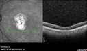 Outer-Retinal-Tubulation-jomi-082318_002.jpg