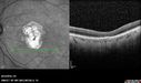Outer-Retinal-Tubulation-jomi-082318_003.jpg