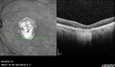 Outer-Retinal-Tubulation-jomi-082318_005.jpg