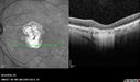 Outer-Retinal-Tubulation-jomi-082318_007.jpg