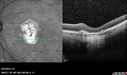 Outer-Retinal-Tubulation-jomi-082318_009.jpg